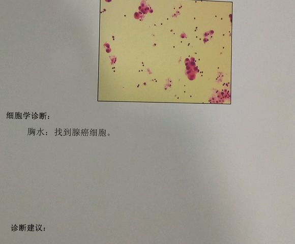 不管中医还是西医给我看看现在吃的国产靶向药吉非替尼