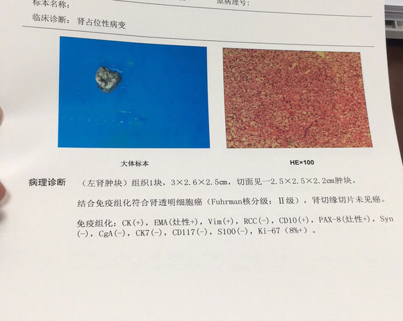 怎么办啊？我妹妹才27岁啊。就得了肾癌啊，天啦！