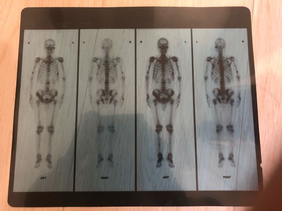 我父亲52岁，在我过生日那天确诊胰腺癌晚期